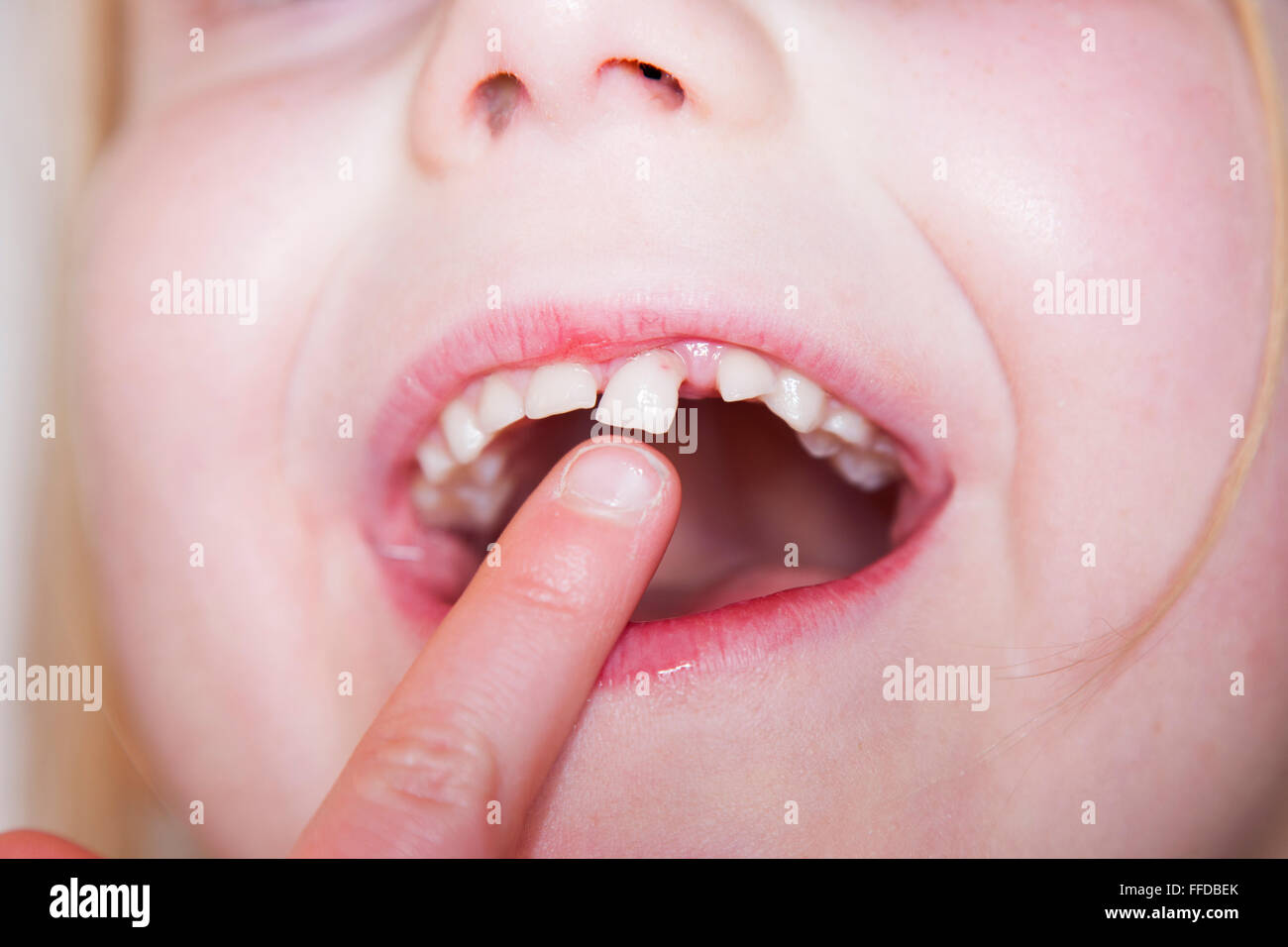 Milk teeth fall out hires stock photography and images Alamy