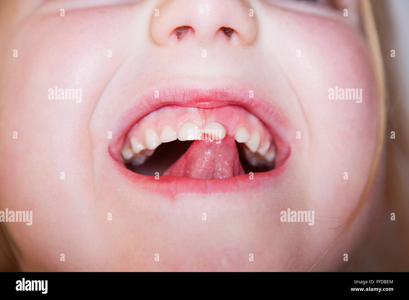 Child / five year old Child's loose front milk teeth / central incisor tooth which is about to fall out from the gum and mouth. Stock Photo