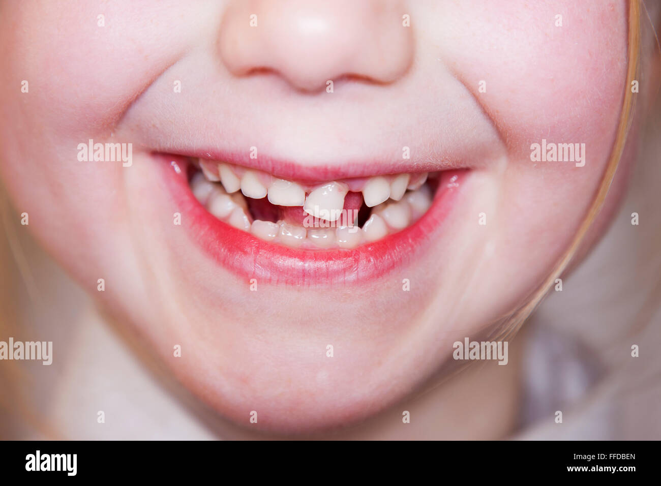 Child / five year old Child's loose front milk teeth / central incisor tooth which is about to fall out from the gum and mouth. Stock Photo