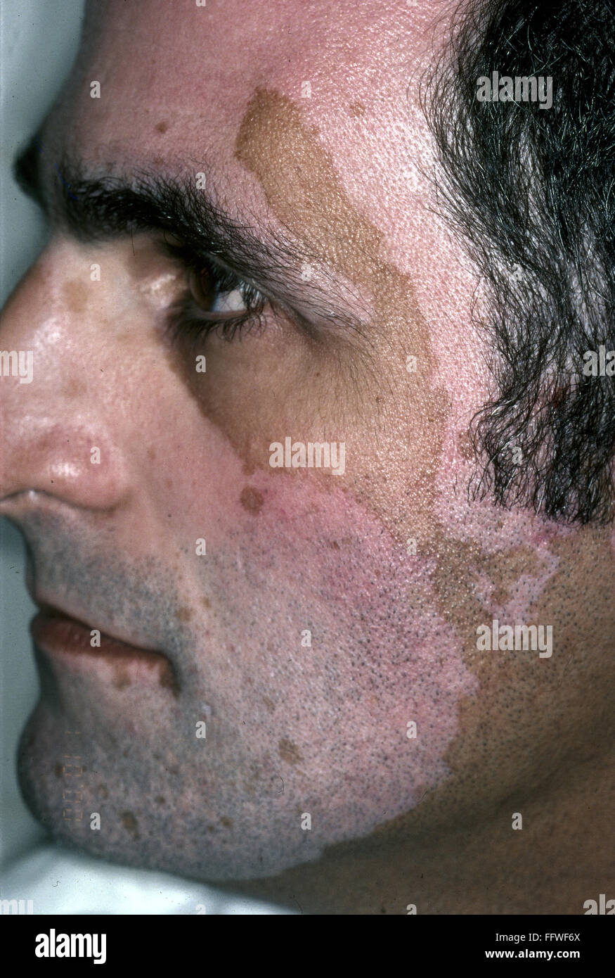 SKIN CONDITION, 2000. /nClose-up of the face of a man suffering from skin discoloration. Photographed in 2000. Stock Photo