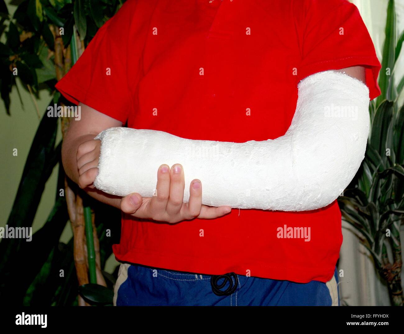 A Short-arm thumb spica cast. B Forearm gauntlet cast.