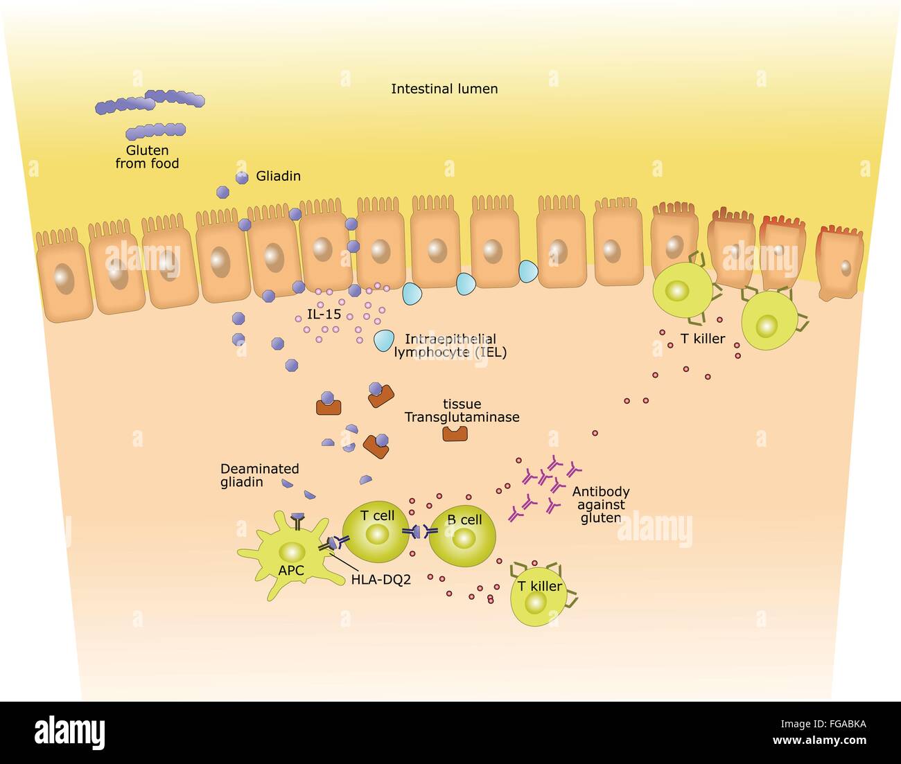 celiac disease: sequence from gluten arrival into the intestinal lumen to auto immune reaction Stock Vector