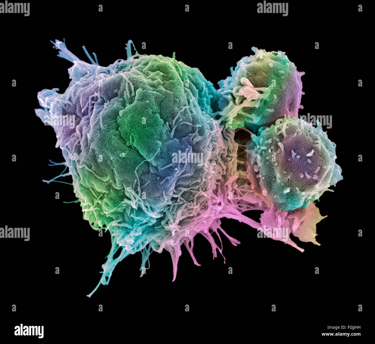 T lymphocytes and cancer cell. Coloured scanning electron micrograph (SEM) of T lymphocyte cells (smaller round cells) attached Stock Photo