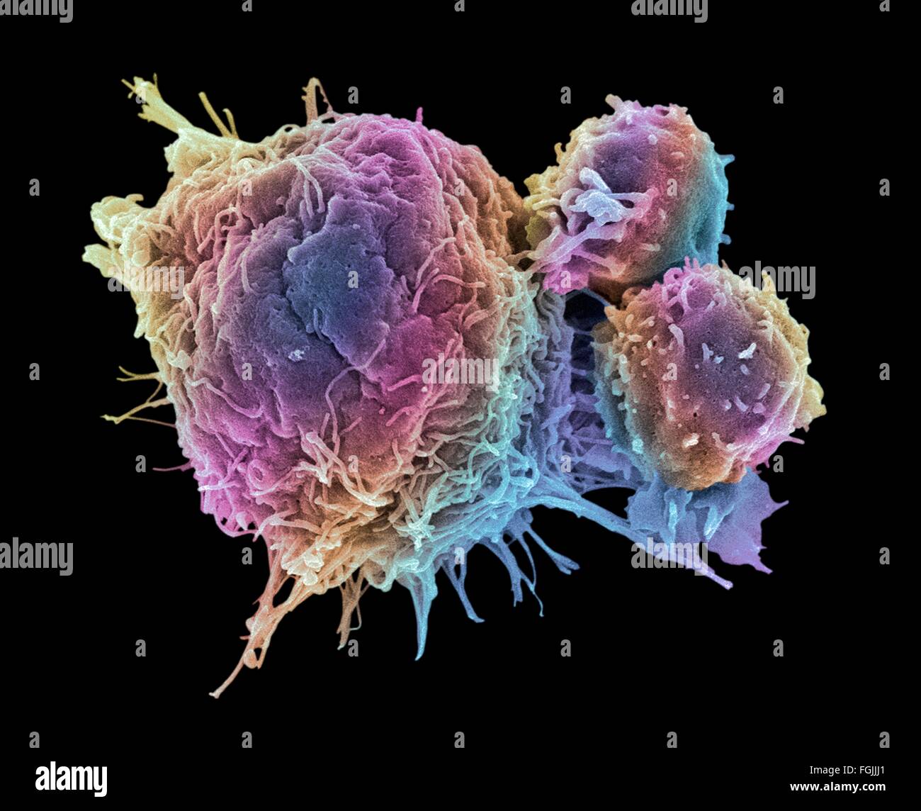 T lymphocytes and cancer cell. Coloured scanning electron micrograph (SEM) of T lymphocyte cells (smaller round cells) attached Stock Photo