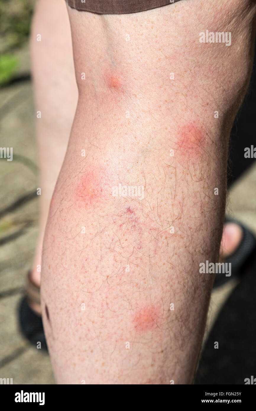 Mosquito bites on leg, Algarve, Portugal Stock Photo