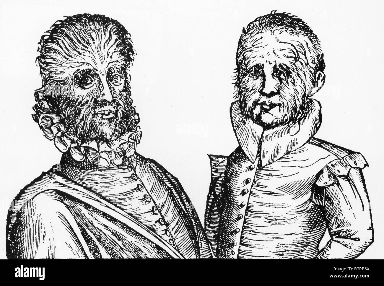 medicine, anomaly, hypertrichosis, two men with hairy faces, woodcut, 17th century, 17th century, graphic, graphics, half length, hairiness, androgenic hair, facial hair, face, faces, facial, malformation, congenital malformations, abnormity, immoderate growth of hair, medicine, medicines, anomaly, anomalies, men, man, woodcut, woodcuts, historic, historical, man, men, male, people, Additional-Rights-Clearences-Not Available Stock Photo