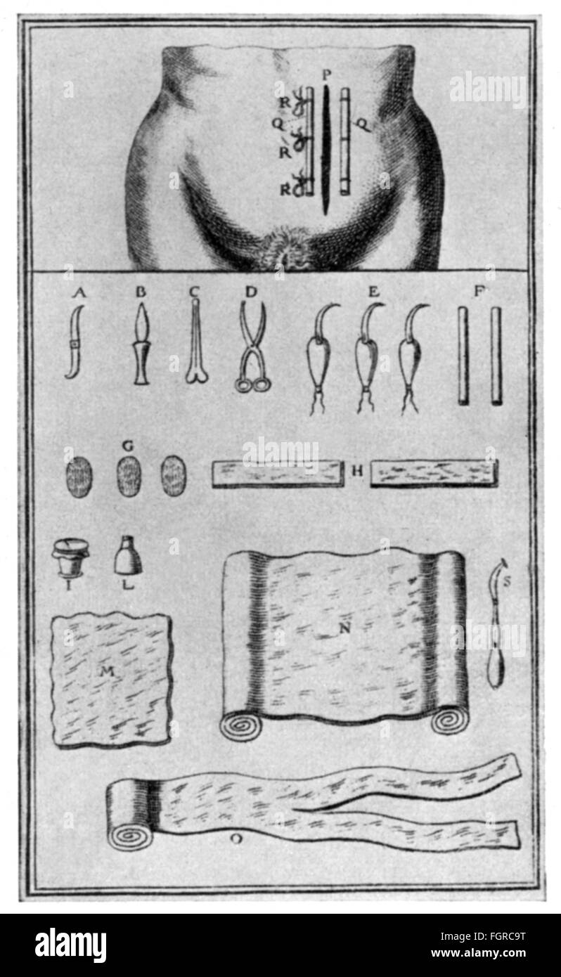 medicine, birth / gynecology, scheme of the stitches and instruments for the Caesarean, copper engraving, out of: Jacques Mesnard, 'Le Guide des Accoucheurs', Paris, 1753, Artist's Copyright has not to be cleared Stock Photo