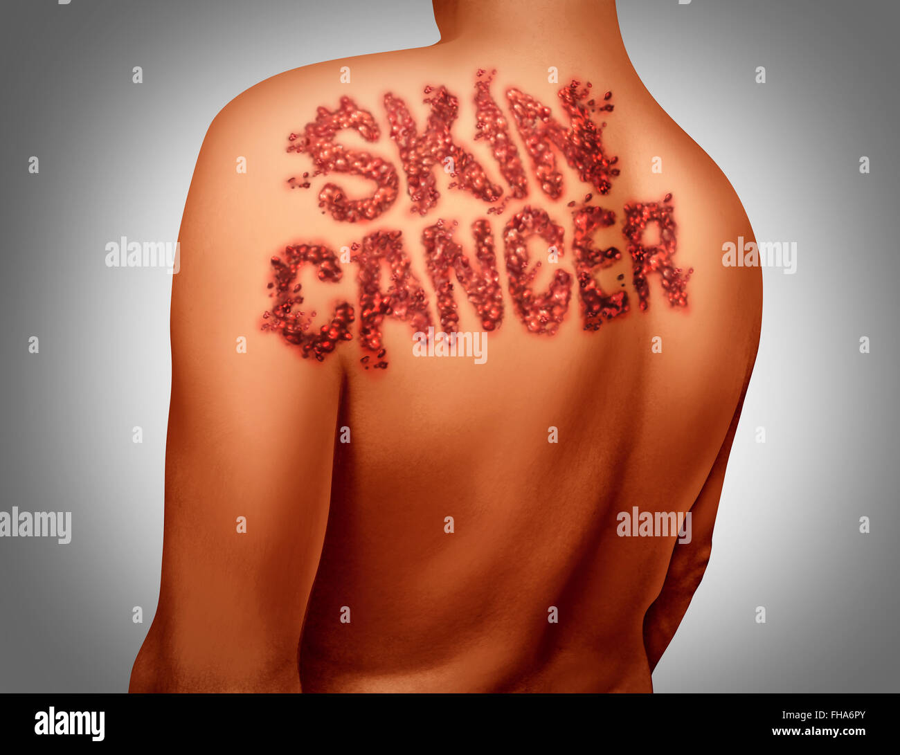 Skin cancer melanoma disease concept as a medical symbol of the human epidermis anatomy being attacked by malignant cancerous dark mole shaped as text on the body. Stock Photo