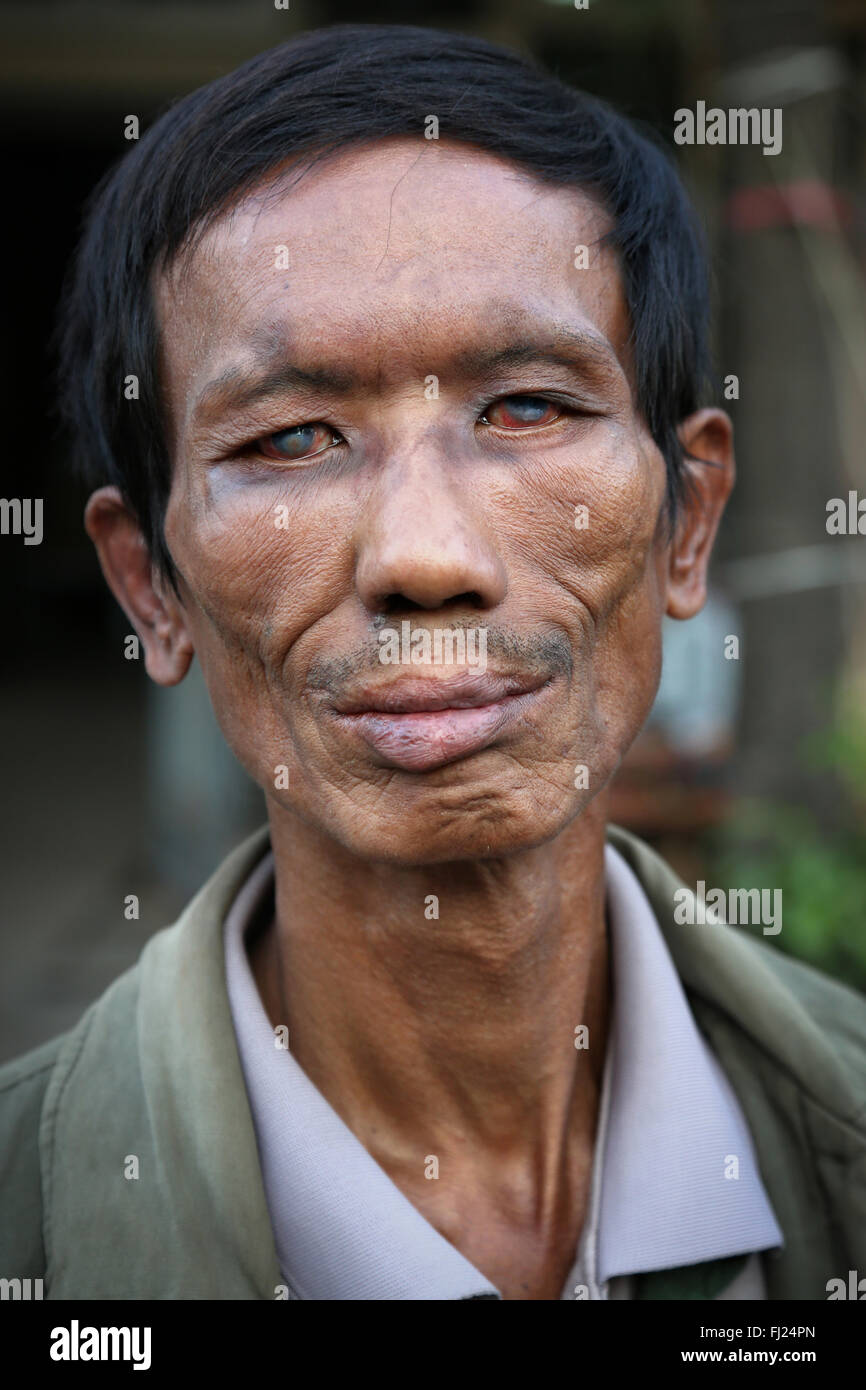 Portrait of blind man in  Myanmar - Burmese people Stock Photo