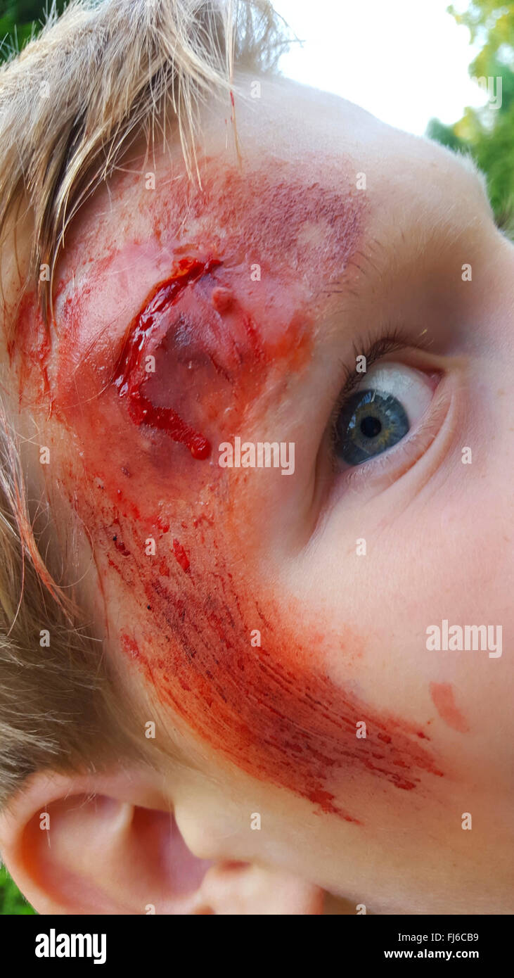 deep wound at the forehead of a child Stock Photo