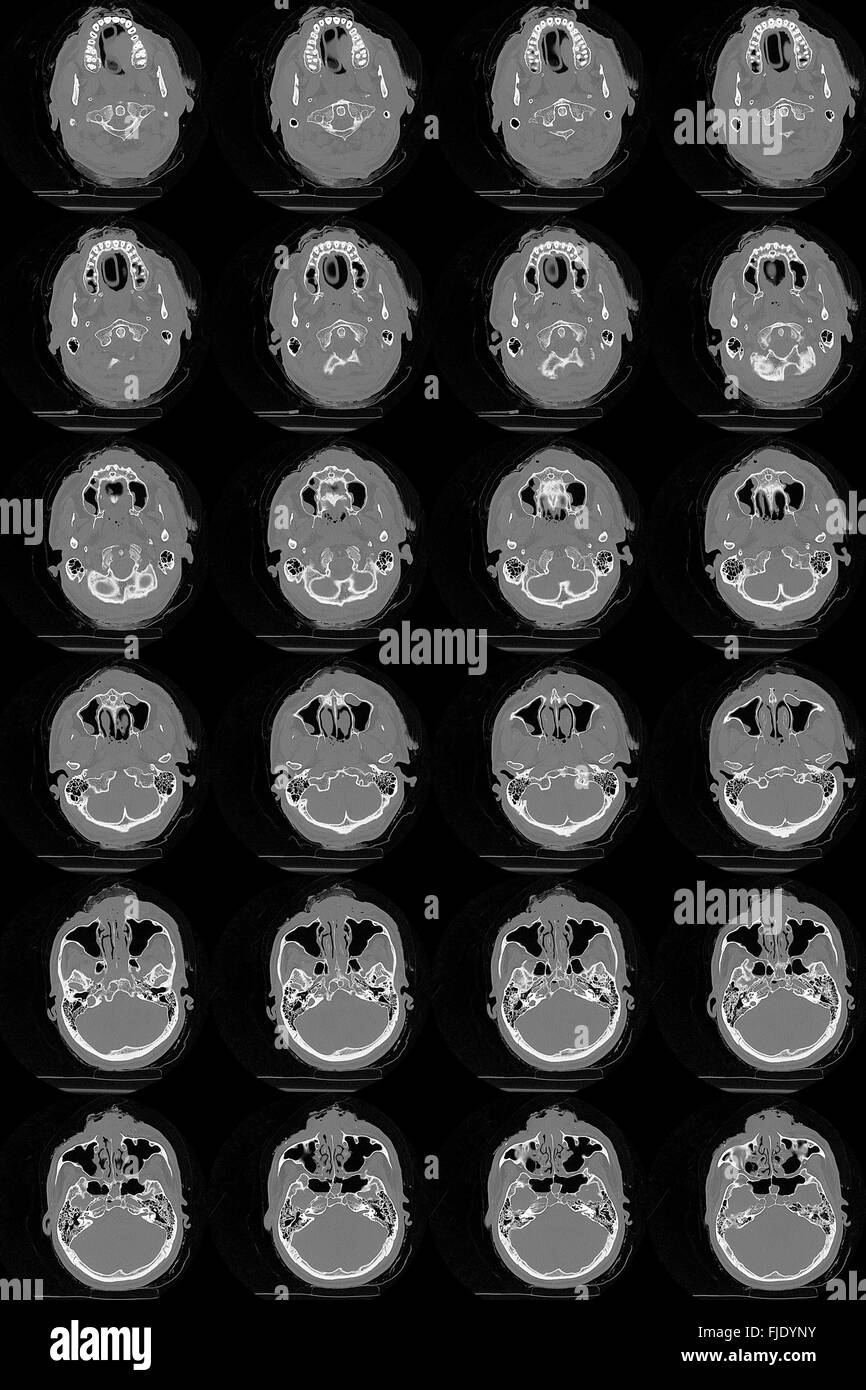 3d Ct Scan Head Stock Photos & 3d Ct Scan Head Stock Images Alamy
