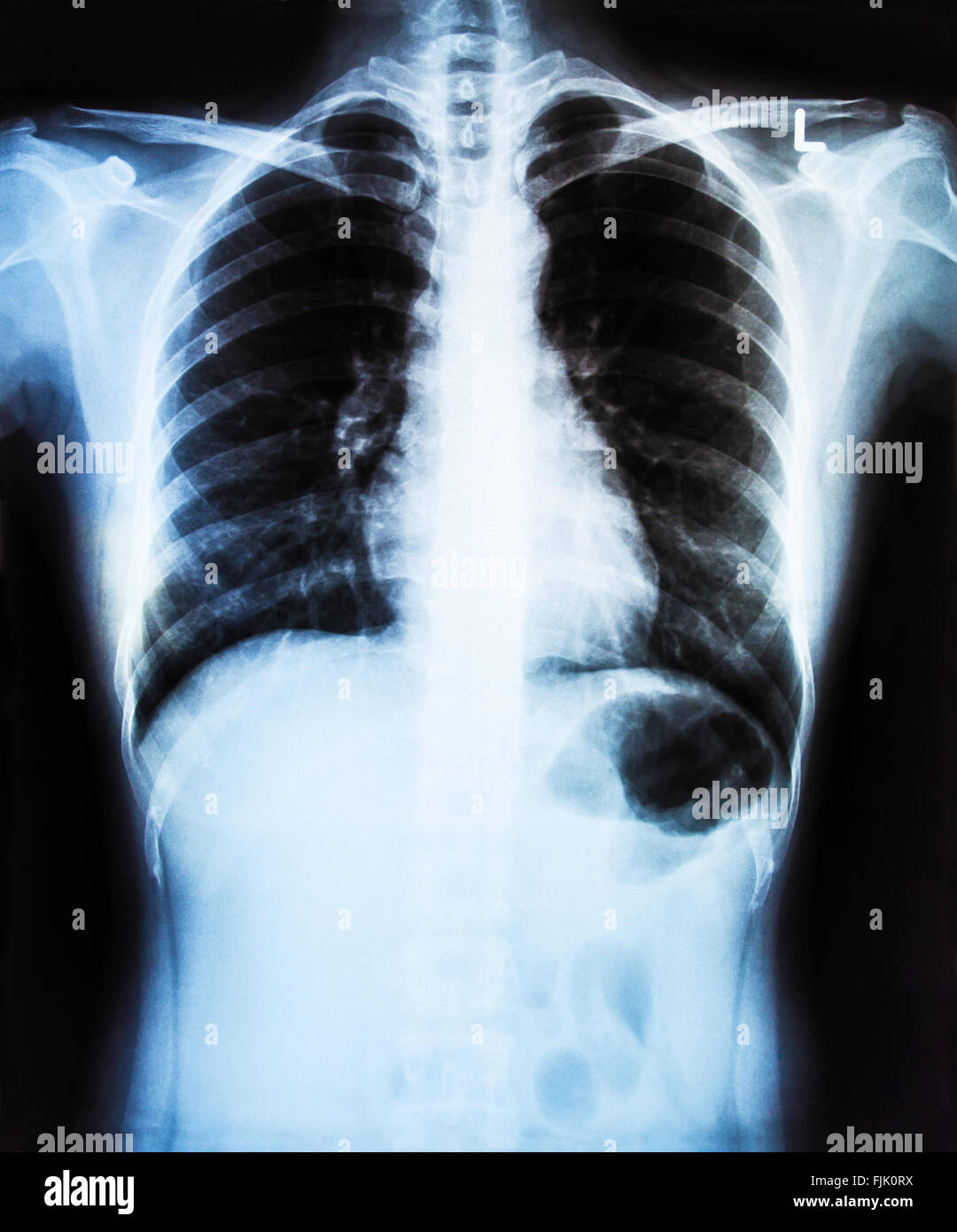 A photo of X-Ray Image Of Human Chest for a medical diagnosis Stock Photo