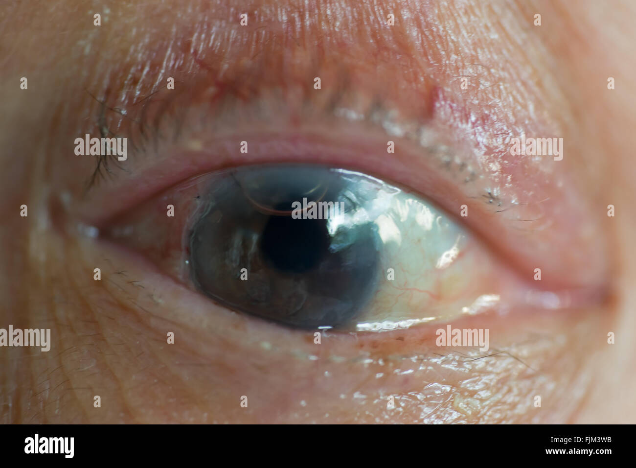 Old man's eye with trace of cornea surgical operation, air bubble, and silk suture Stock Photo
