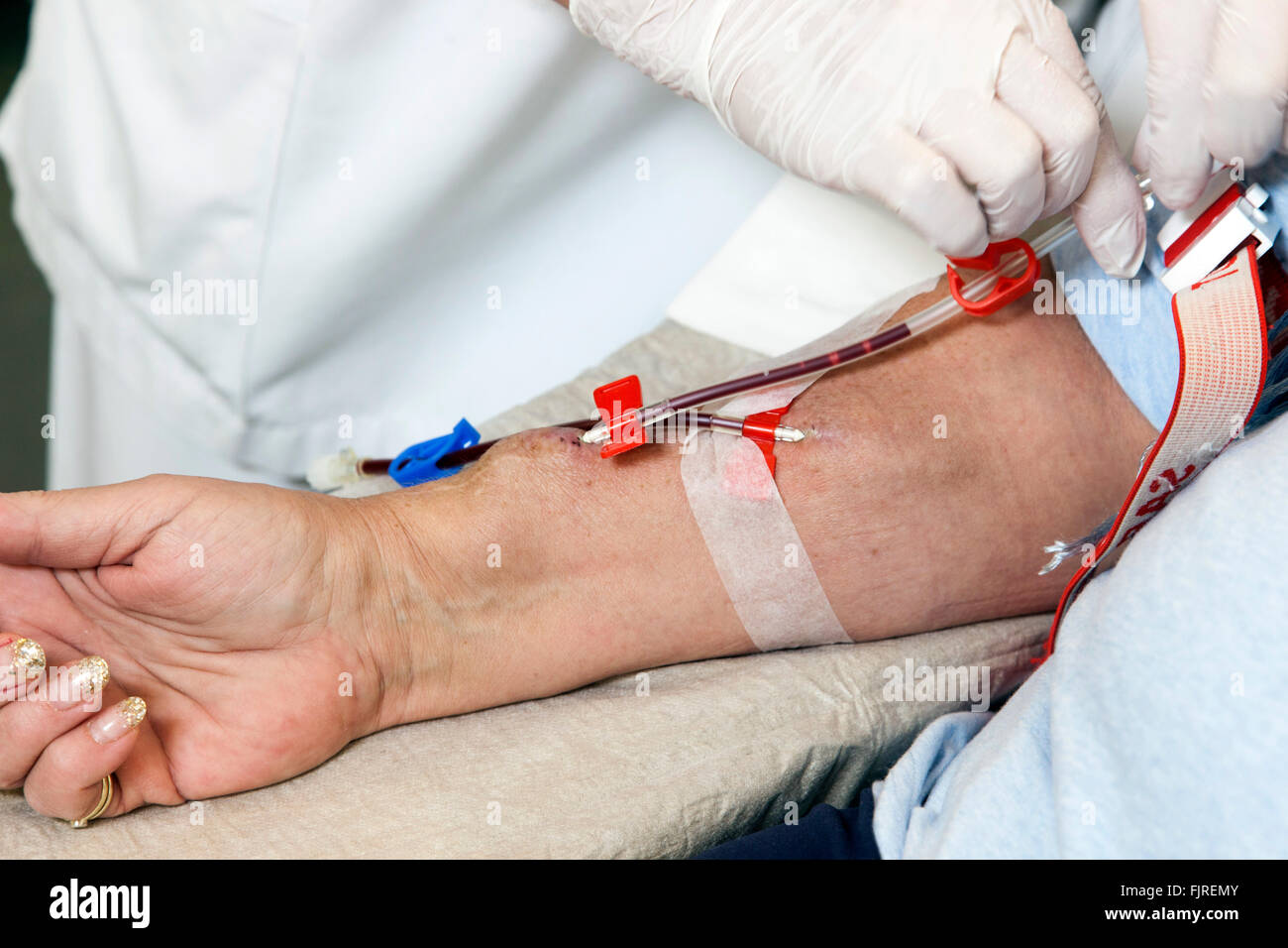 Renal dialysis shunt hi-res stock photography and images - Alamy