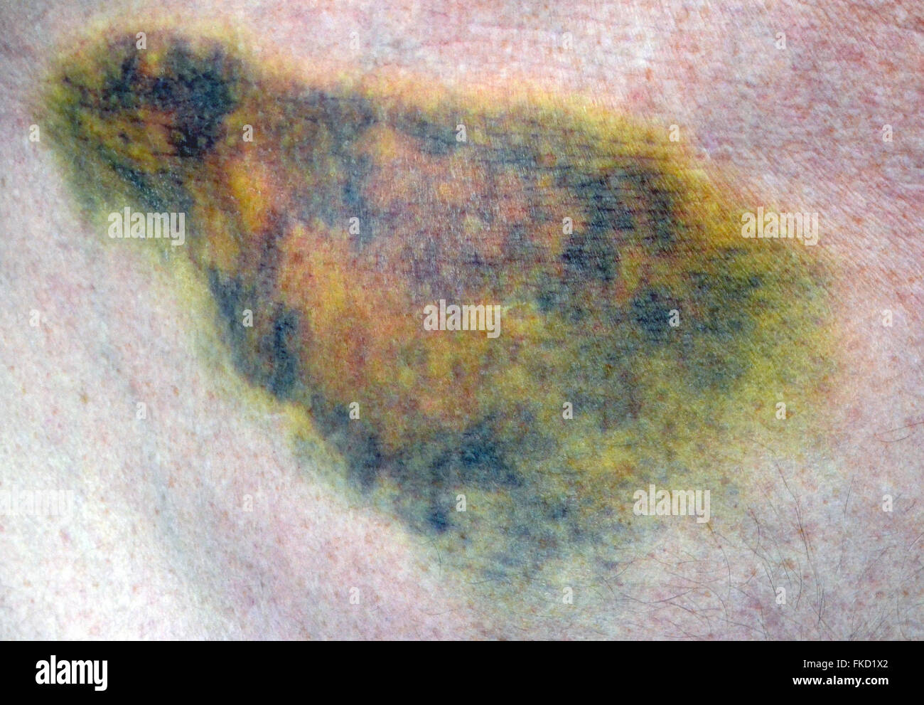 This close-up shows the multicolored effects of a body bruise on the stomach of a Caucasian man who fell and broke small blood vessels that leaked into the tissues under the skin. Bruises often turn various colors as they heal but usually fade away within two to four weeks without any long-lasting harm to the person. Stock Photo