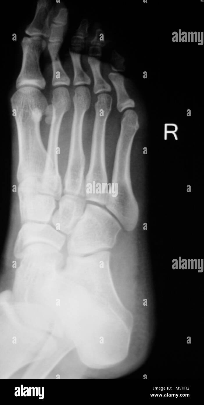 Foot and toes injury Traumatology medical x-ray Orthopedic test scan image. Stock Photo