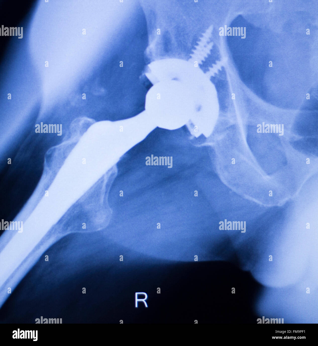 Hip replacement xray orthopedic medical xray Traumatology test scan