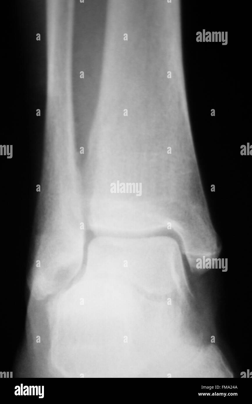 Shin, lower leg and ankle injury Traumatology medical xray Orthopedic
