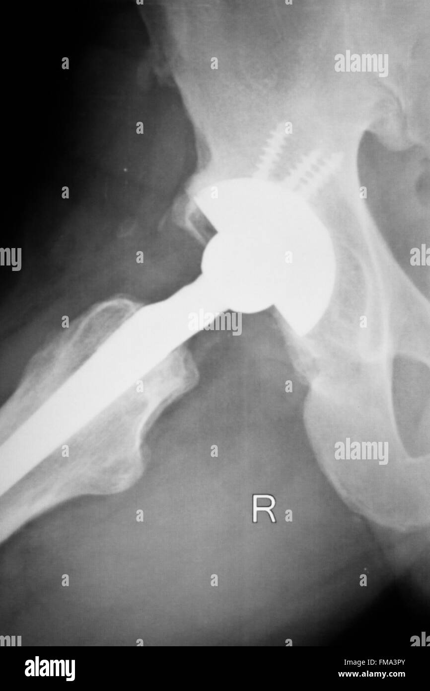Hip replacement xray orthopedic medical xray Traumatology test scan