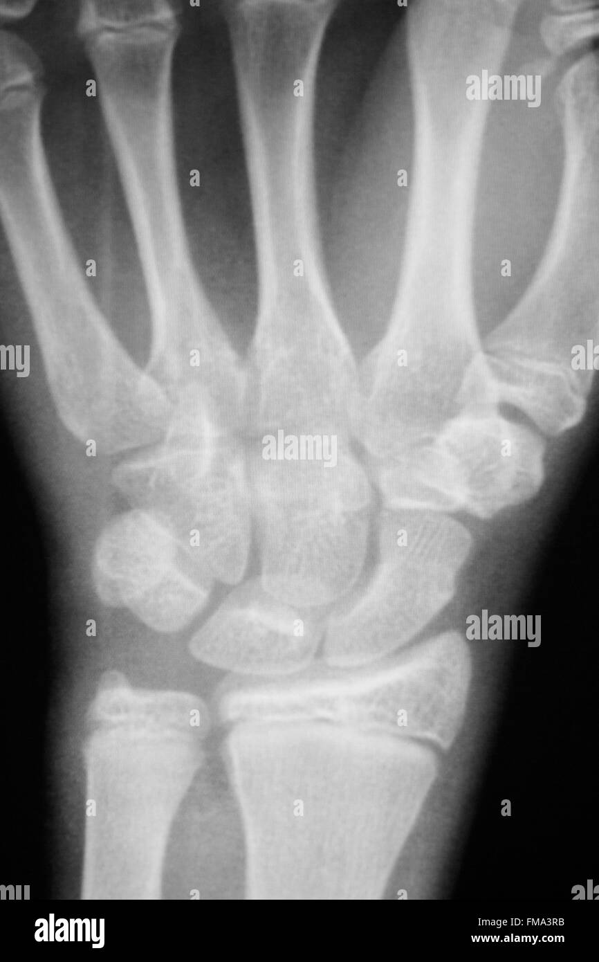 Hand, fingers, thumb and wrist injury orthopedic Traumatology medical x-ray test scan image. Stock Photo