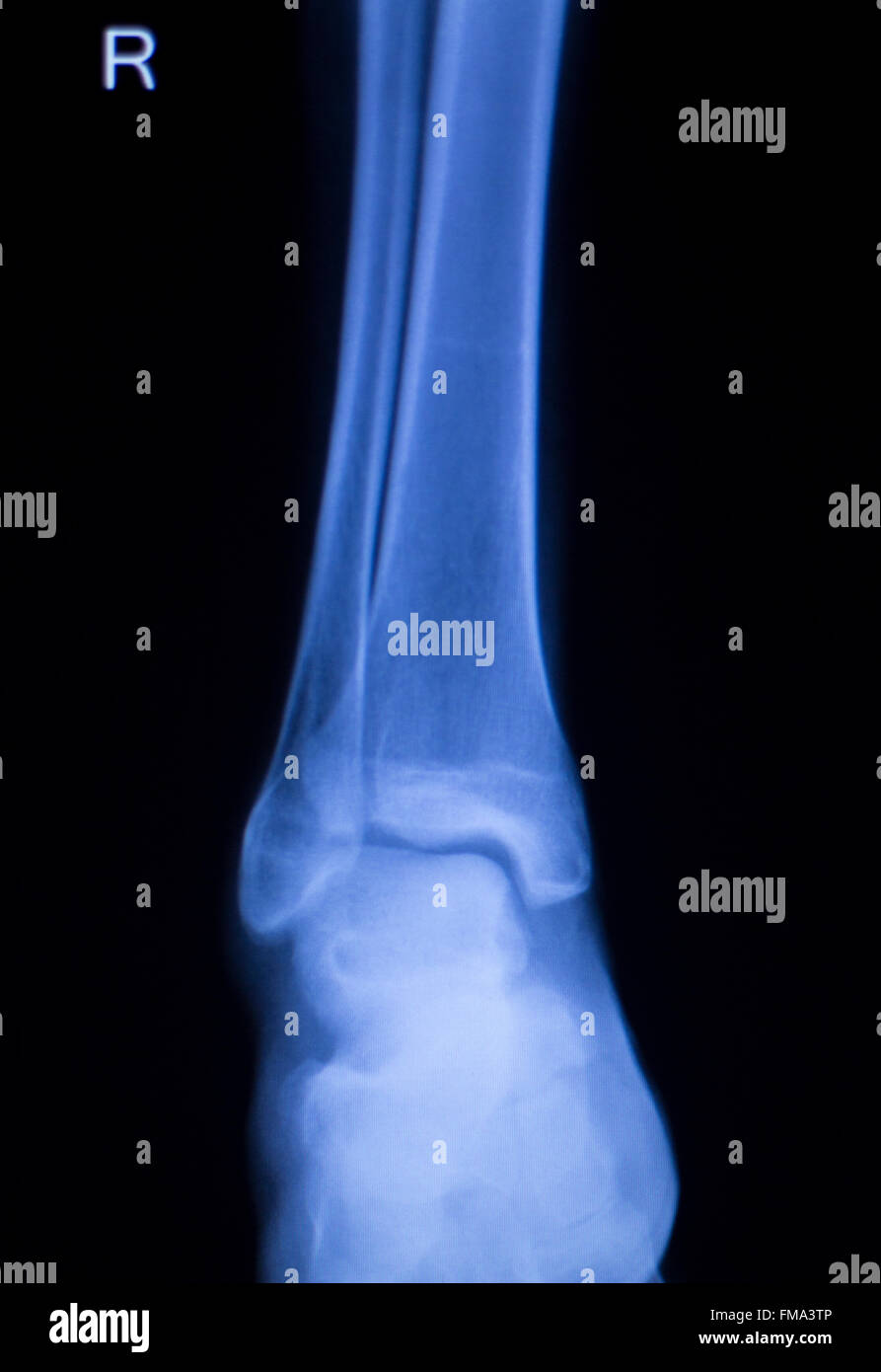 Shin, lower leg and ankle injury Traumatology medical xray Orthopedic