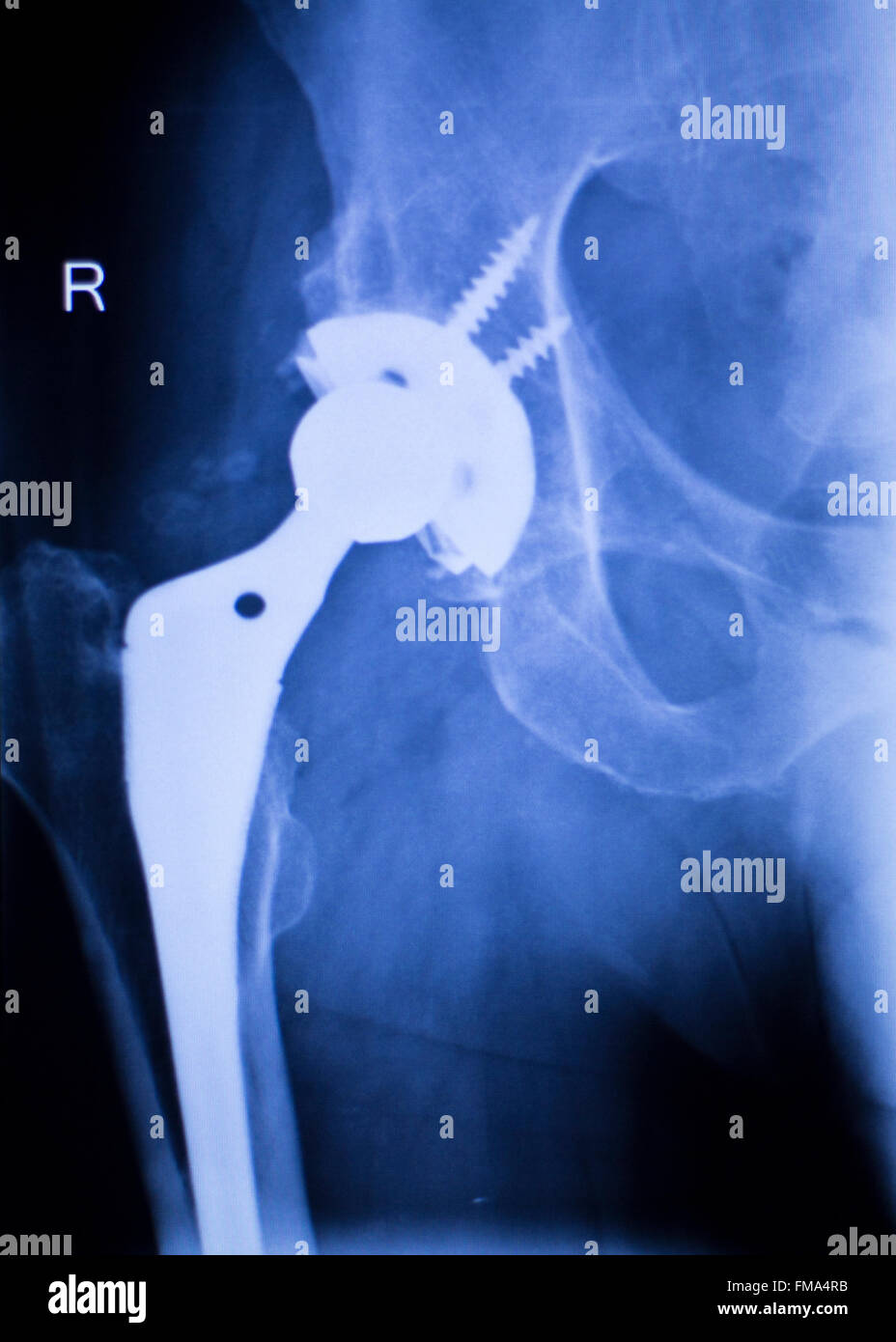 Hip replacement xray hires stock photography and images Alamy