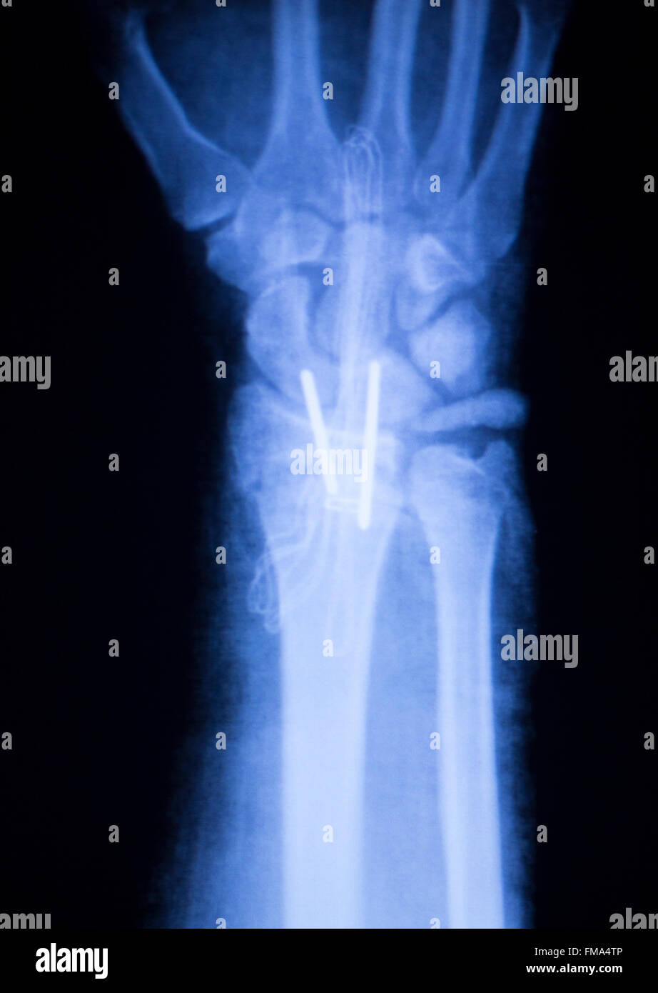Forearm orthopedic titanium metal replacement implant xray scan test results. Stock Photo