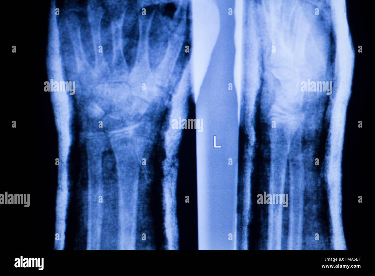 Forearm, arm and wrist injury xray scan test reults to diagnose pain ...