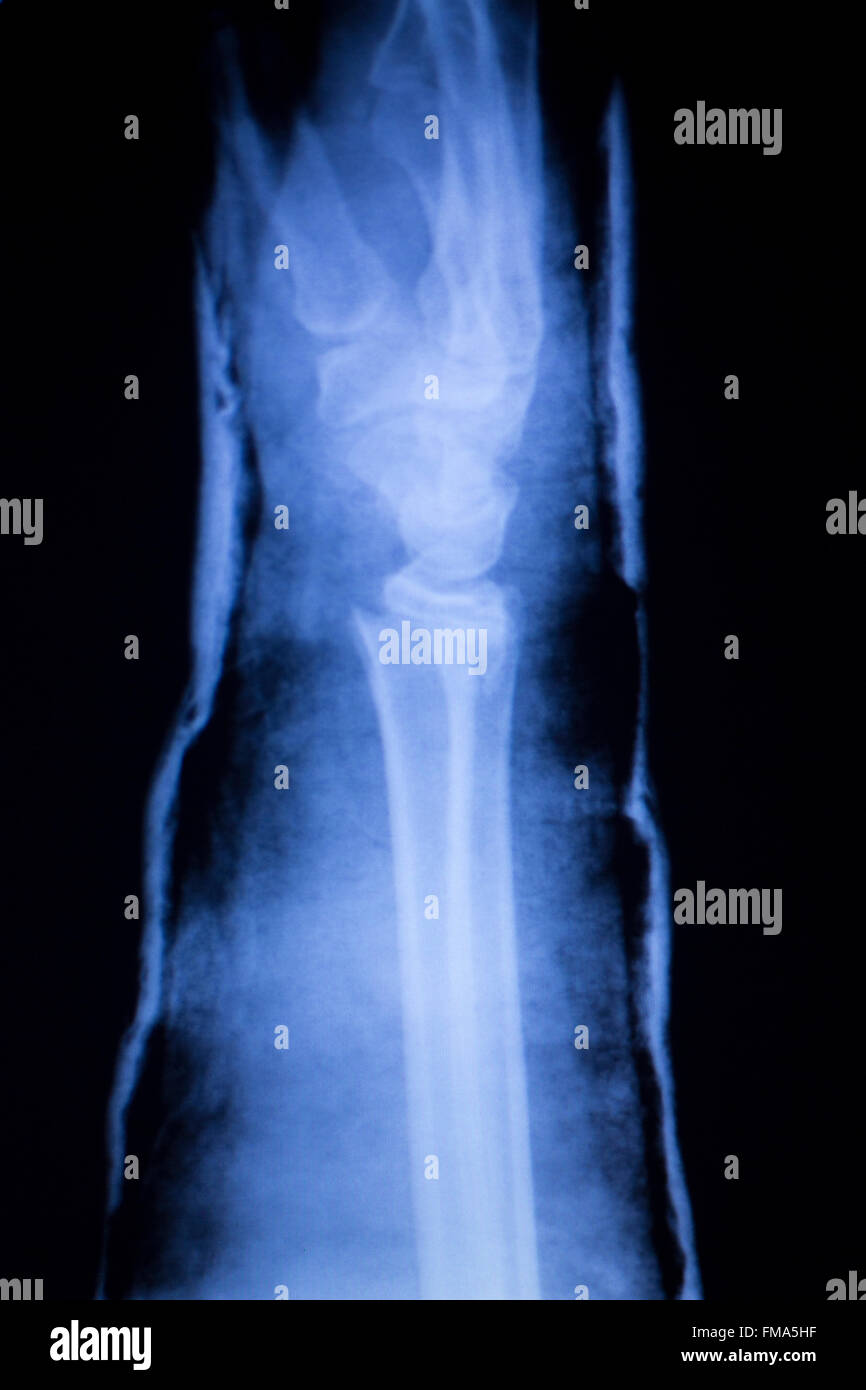 Forearm, arm and wrist injury xray scan test reults to diagnose pain
