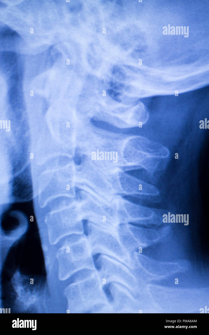 Skull, neck, spine, vertebra and shoulders injury medical x-ray test ...