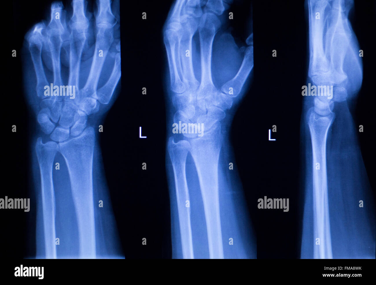 Hand, fingers, thumb and wrist injury orthopedic Traumatology medical x
