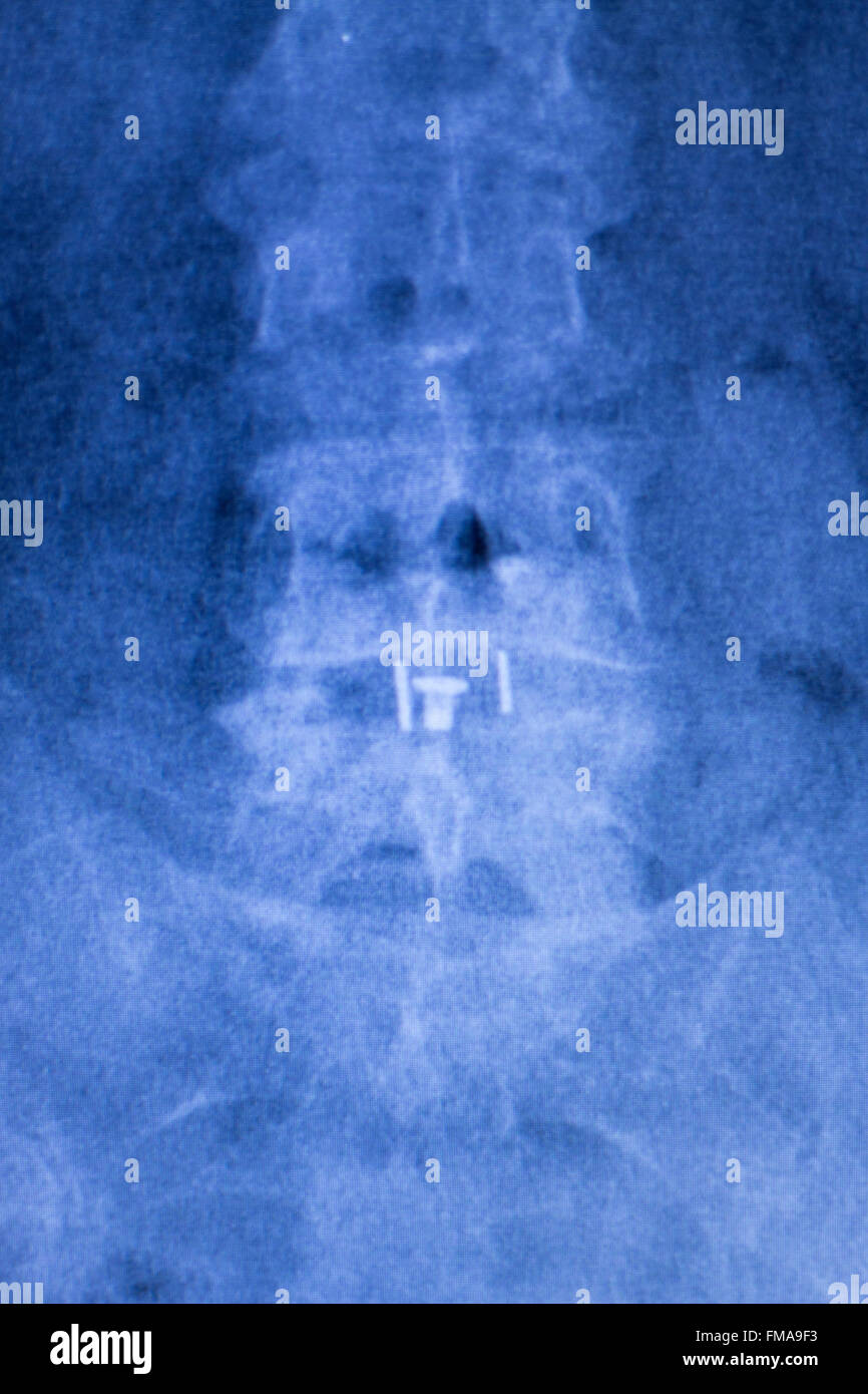 Spine, back and neck orthopedic titanium metal spinal plate and screw