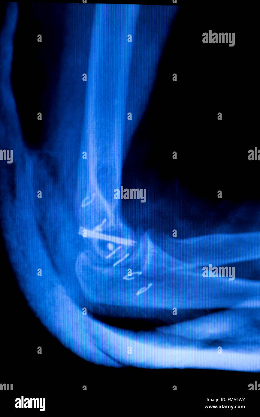 Elbow, arm and forearm orthopedic titanium metal replacement implant