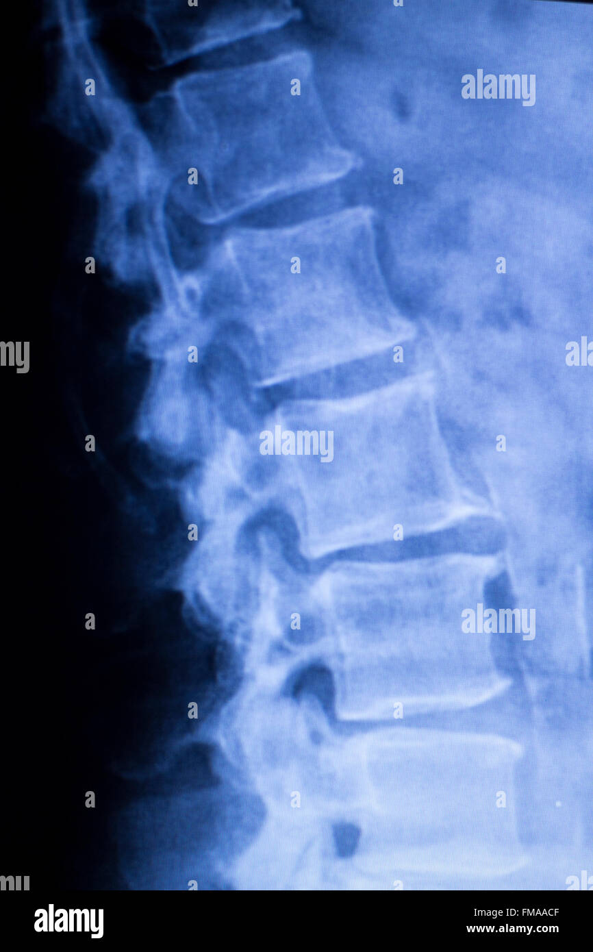 Spine vertebra back injury vertebral column medical x-ray test scan ...