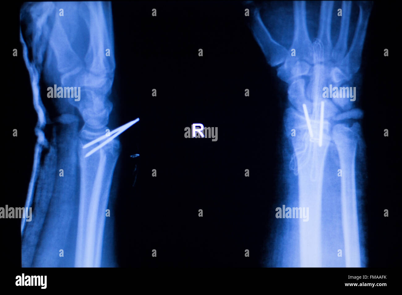 Forearm orthopedic titanium metal replacement implant xray scan test results. Stock Photo