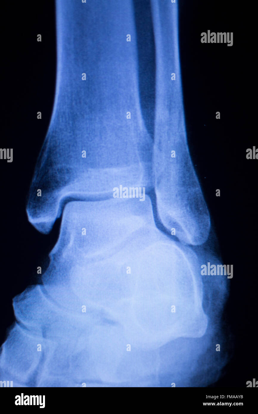 Shin, lower leg and ankle injury Traumatology medical xray Orthopedic