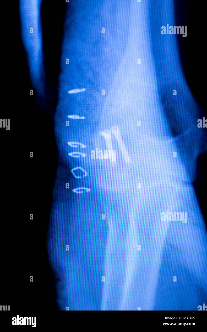 Elbow, arm and forearm orthopedic titanium metal replacement implant