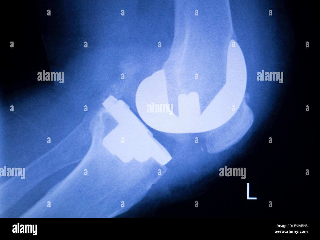 Knee joint meniscus orthopedic titanium metal replacement implant xray