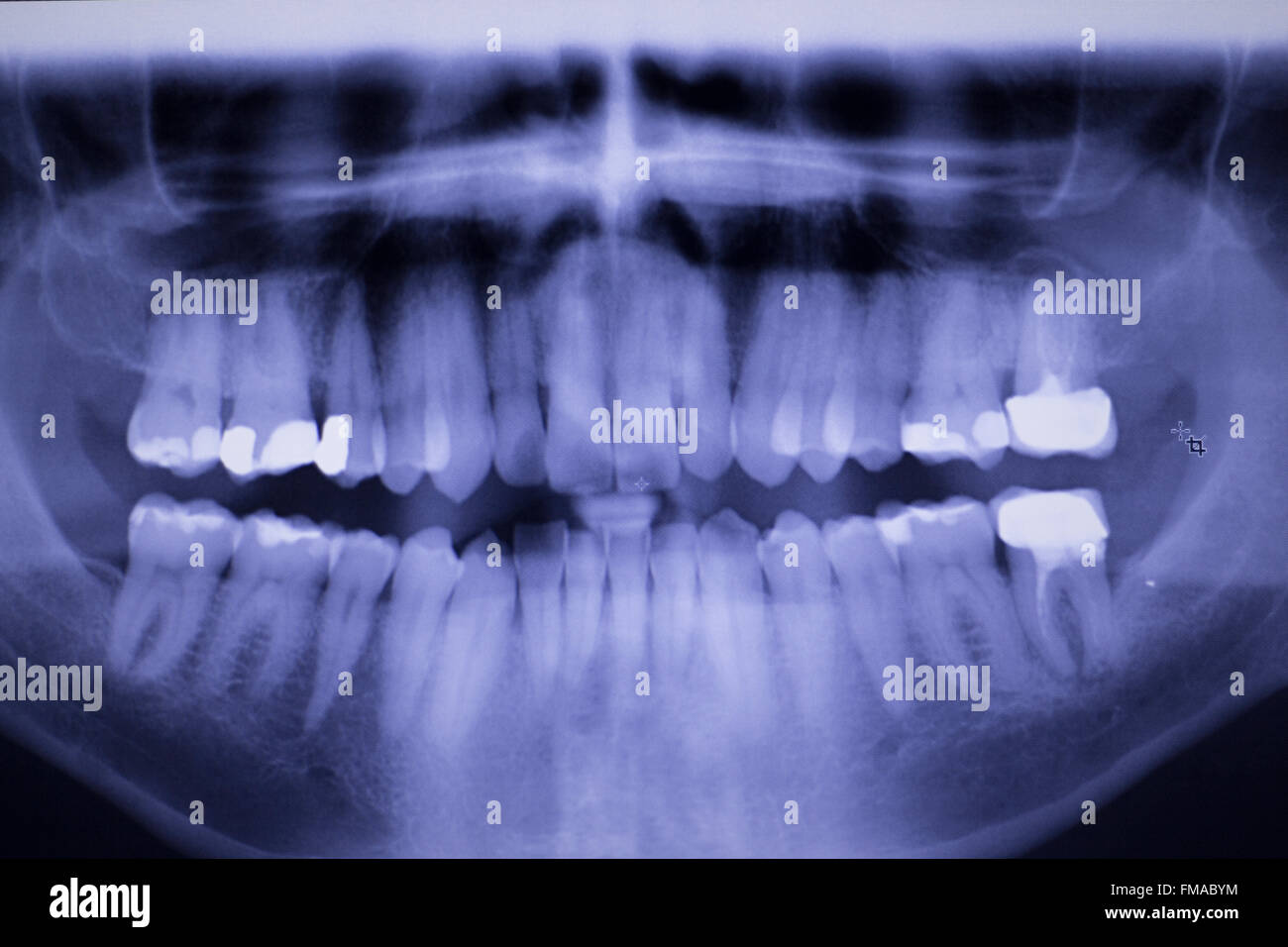 Dental teeth fillings, gum disease gingivitis dentists medical tooth x