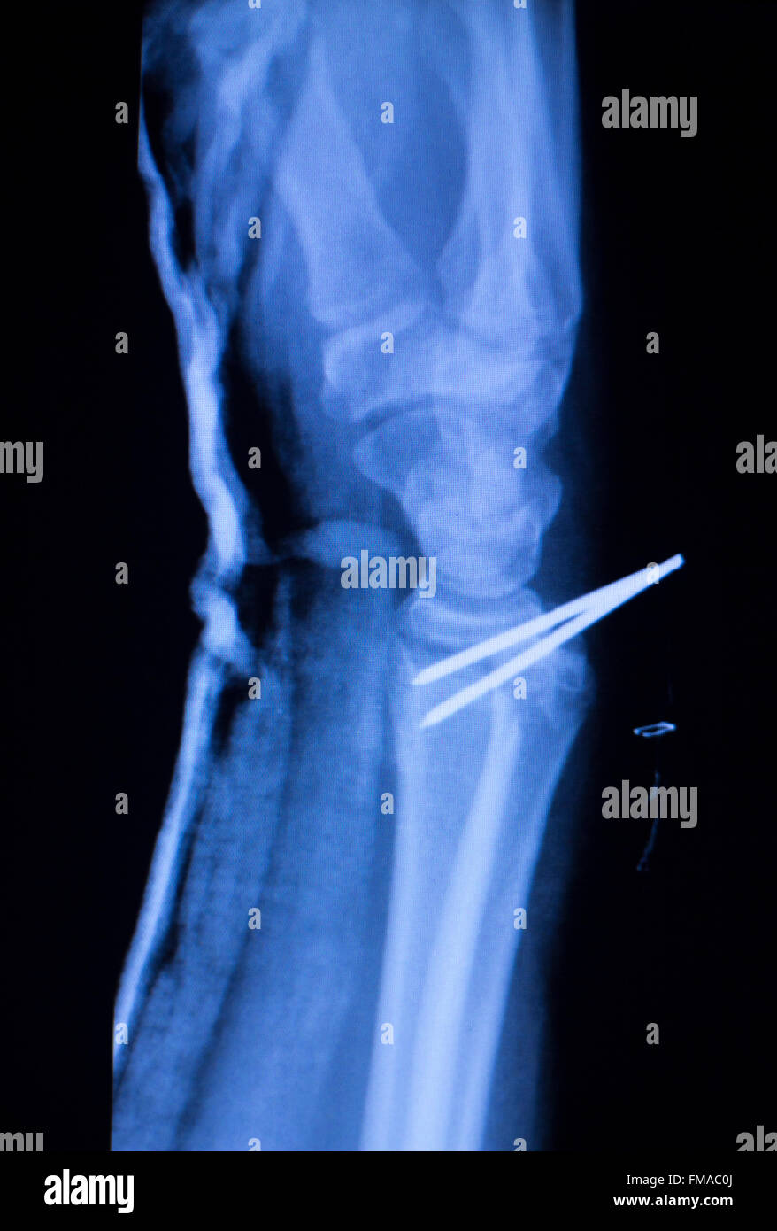 Forearm orthopedic titanium metal replacement implant xray scan test reults. Stock Photo