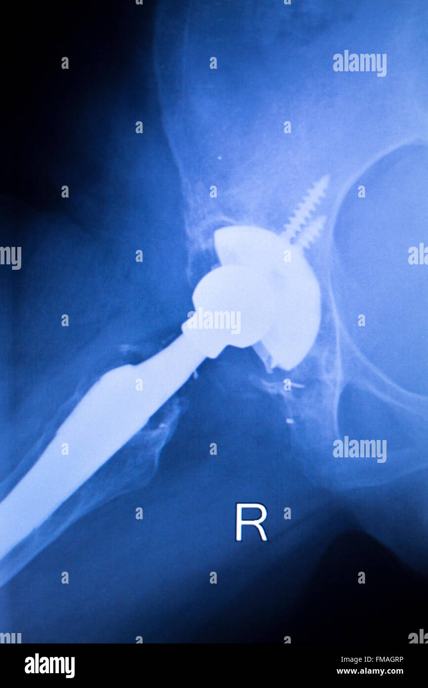 Hip joint meniscus orthopedic titanium metal replacement implant xray ...