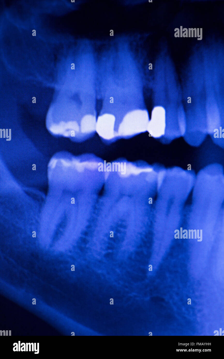 Dental teeth fillings, gum disease gingivitis dentists medical tooth x