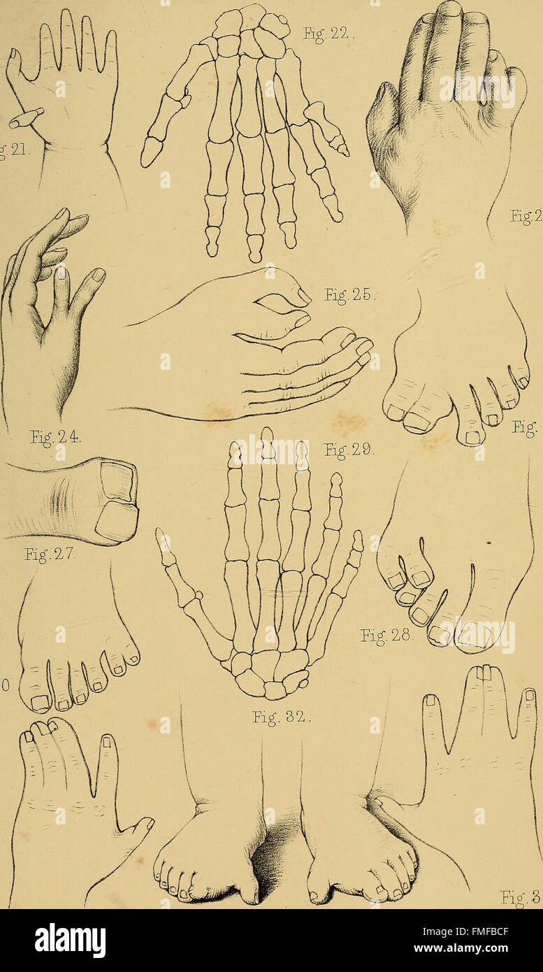 Degete 'The Malformations, Diseases and Injuries of the Fingers and Toes and ...