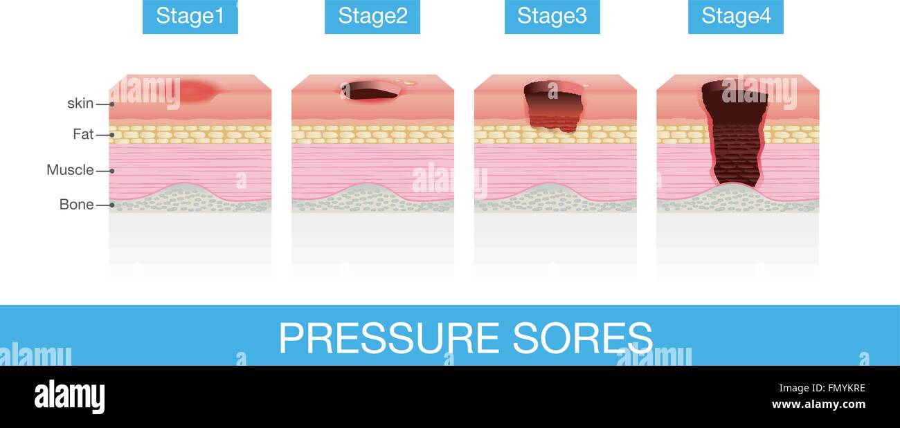 Stages of Pressure Sores Stock Vector