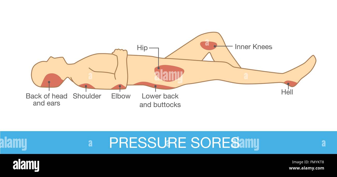 Pressure sores area Stock Vector