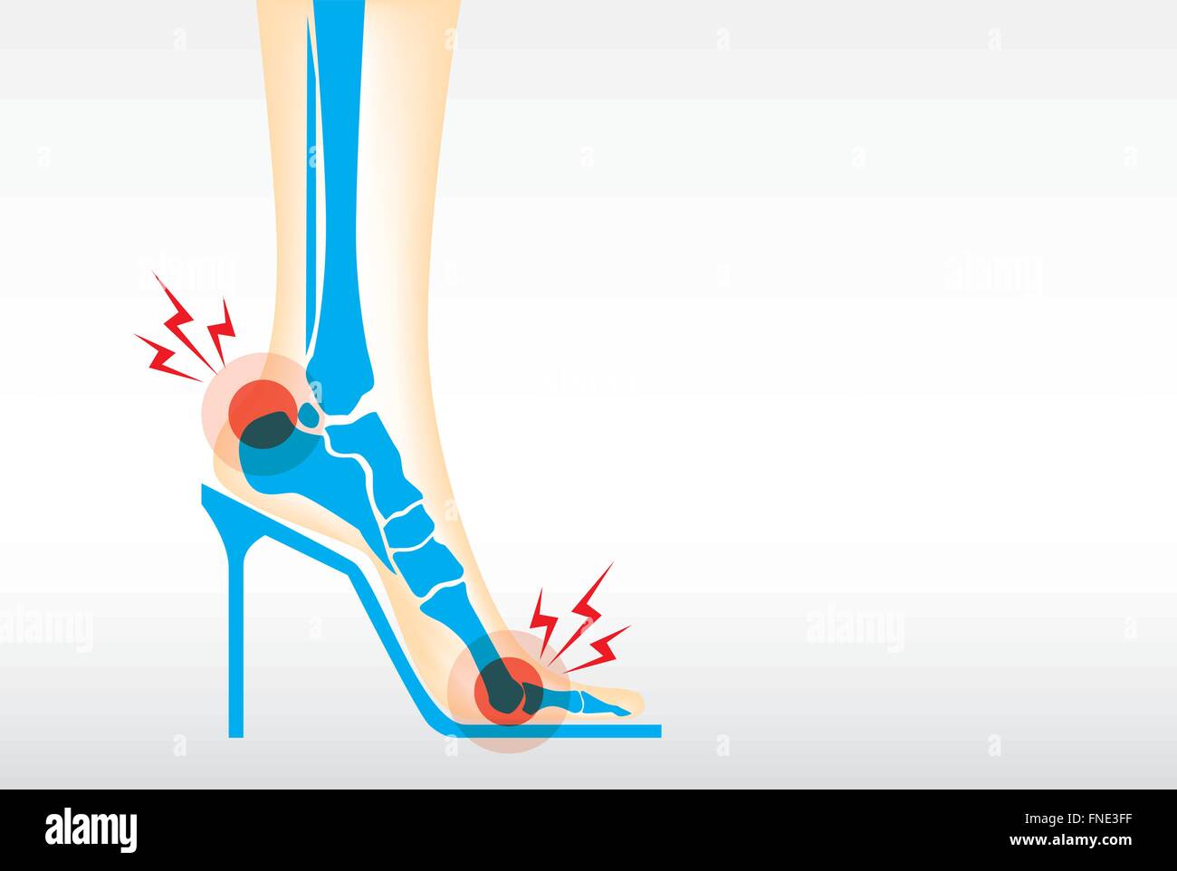 Foot pain by wearing high heels Stock Vector Image & Art Alamy