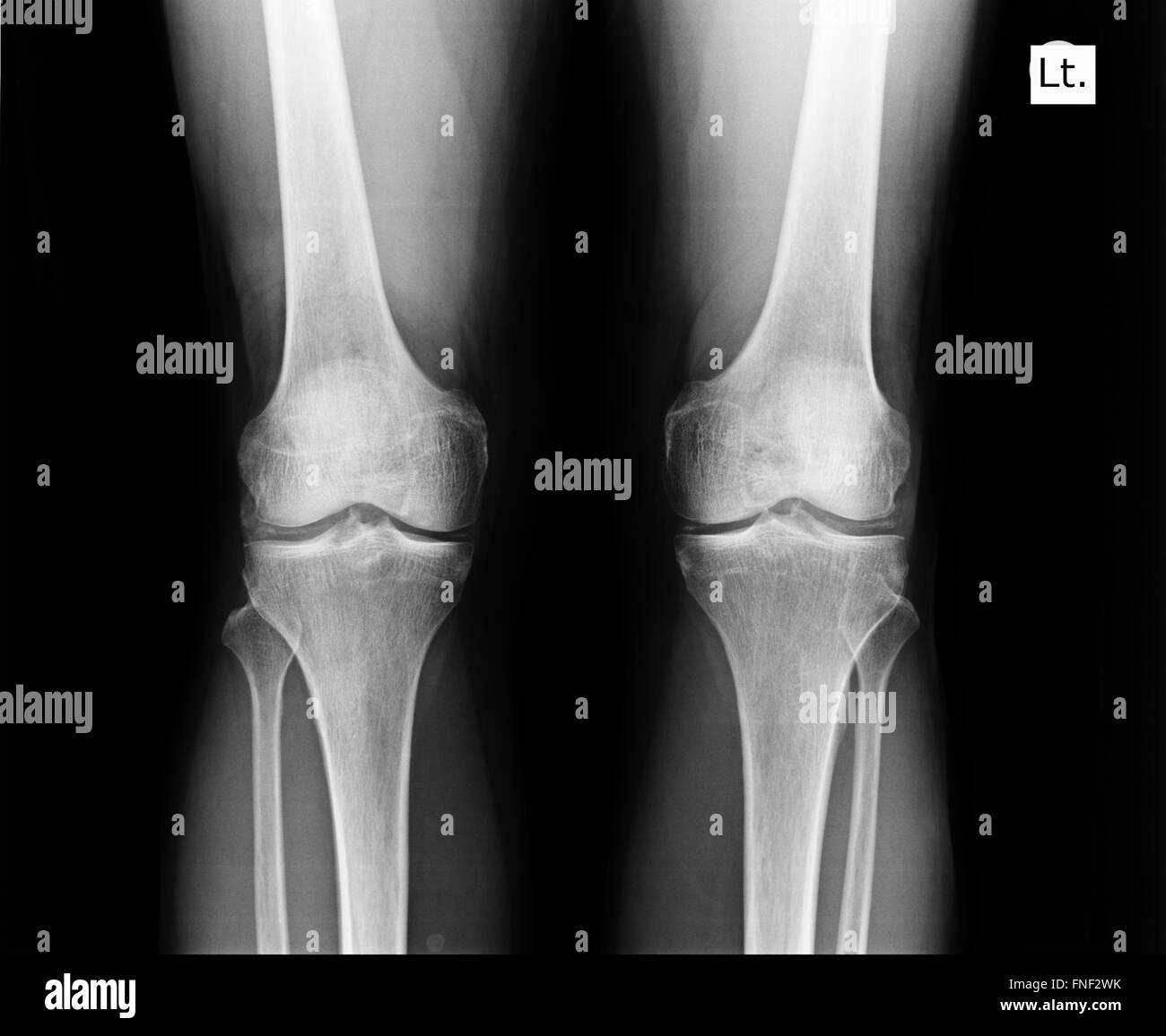 knee with total replacement x-ray image on black background Stock Photo