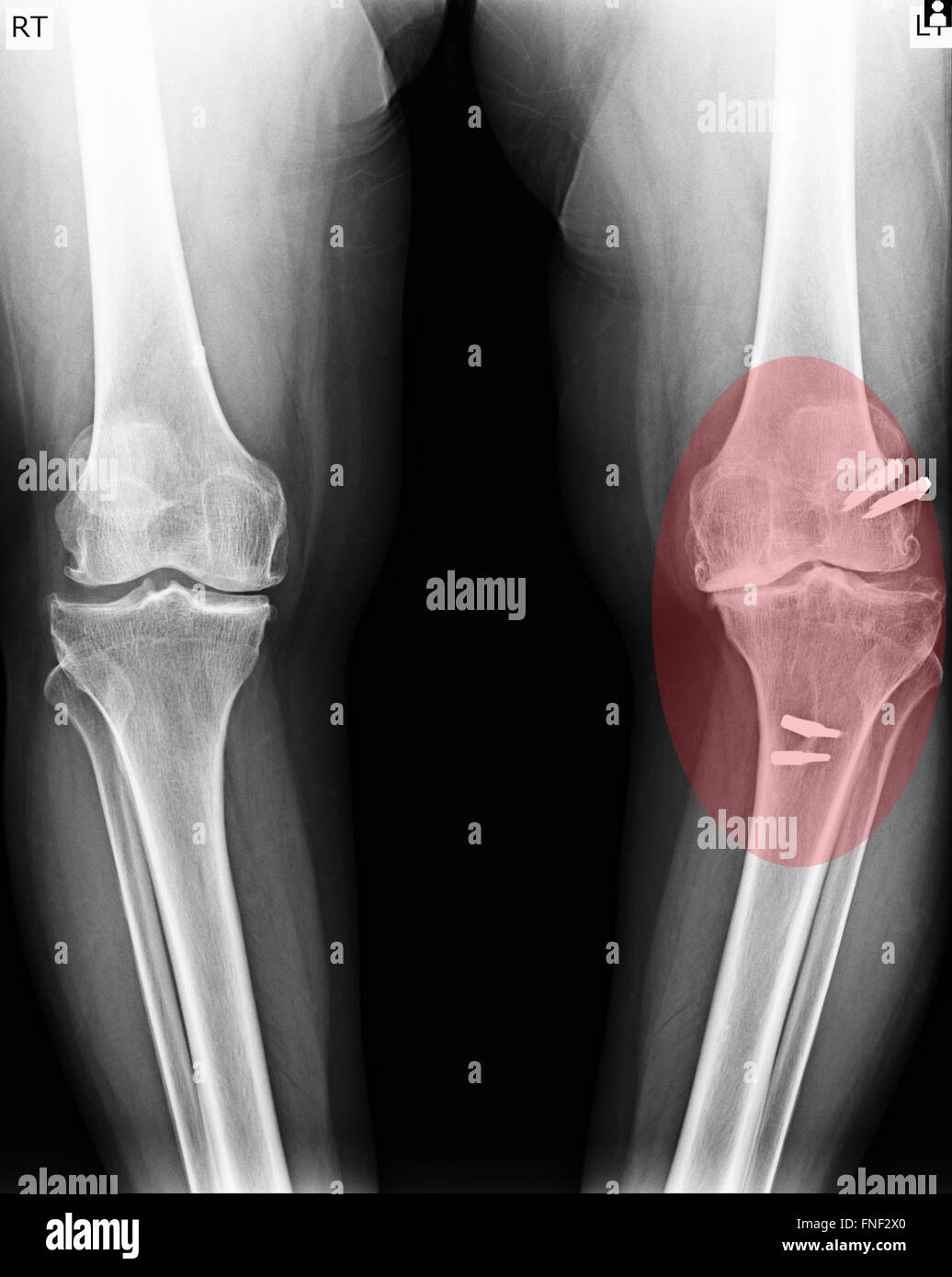 knee with total replacement x-ray image on black background Stock Photo