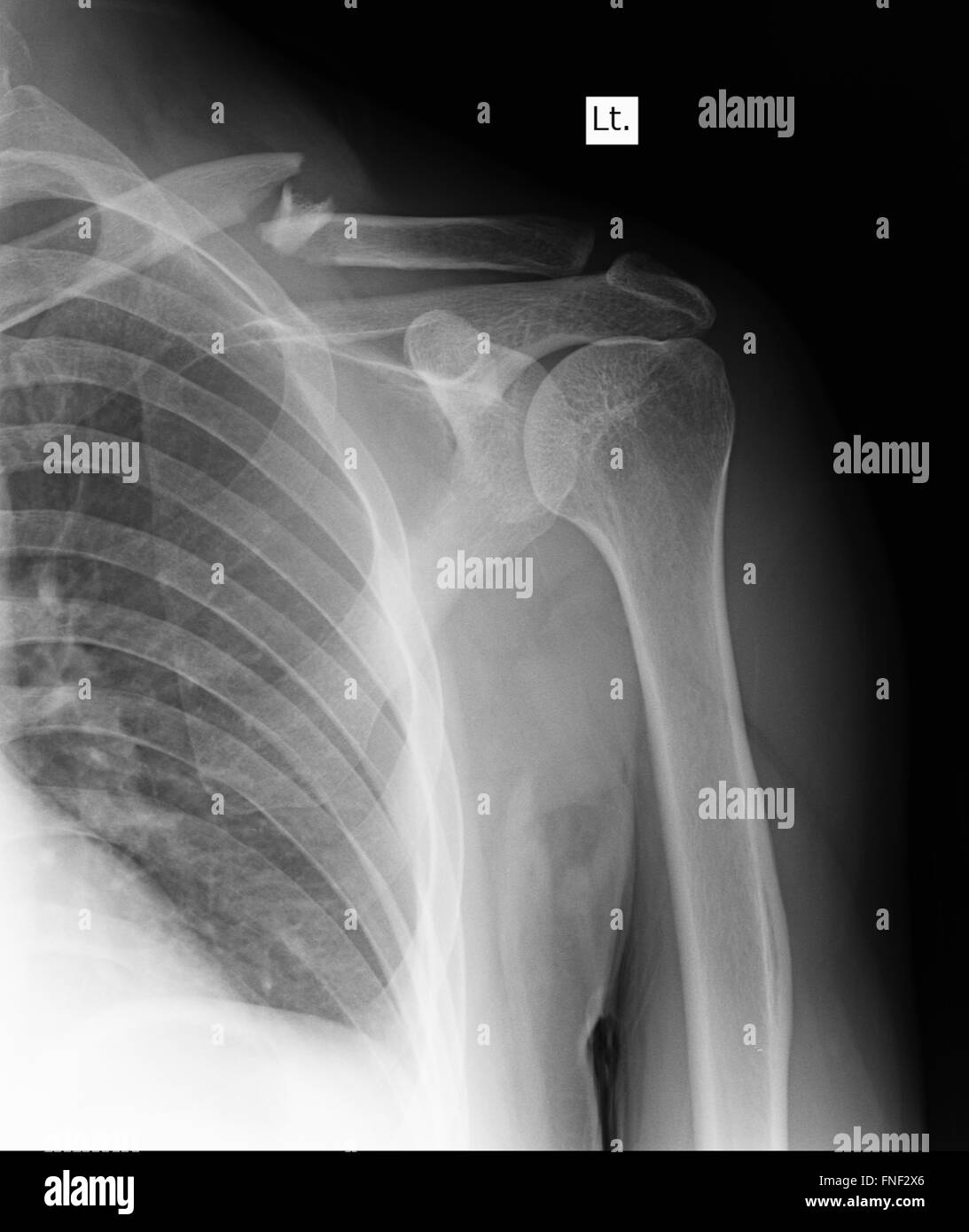 Shoulder xray hires stock photography and images Alamy