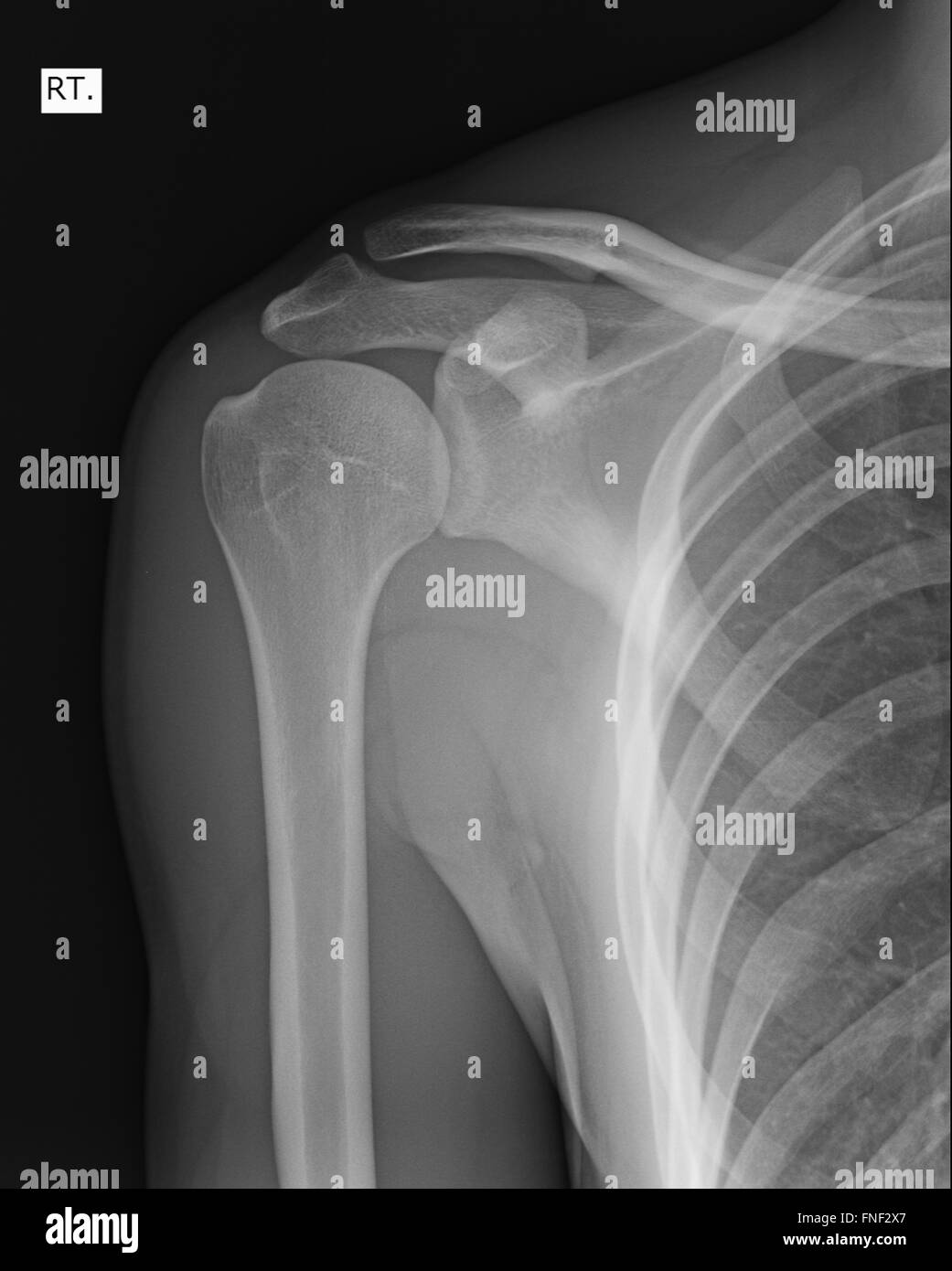 Xray of human shoulder Stock Photo Alamy